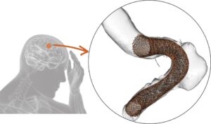 Image illustrant un anévrisme cérébral avec un dispositif médical de type stent à maille sérée inséré pour traitement par embolisation.