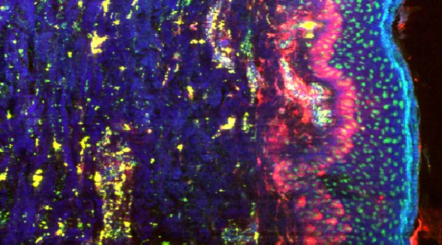 Cartographie des éléments chimiques réalisée sur une coupe histologique de peau: le phospore est bien visible dans le noyau des cellules, le fer dans les zones vascularisées (prolifération), et le potassium assez largement distribué.